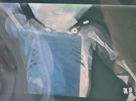 2811-policia-criancabracoquebrado-cleriston2