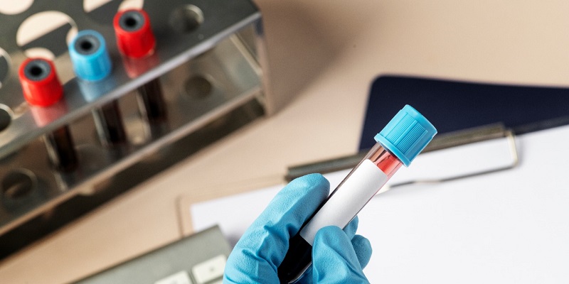 Lacen irá atrasar os resultados dos exames da covid-19 devido a falta de reagente