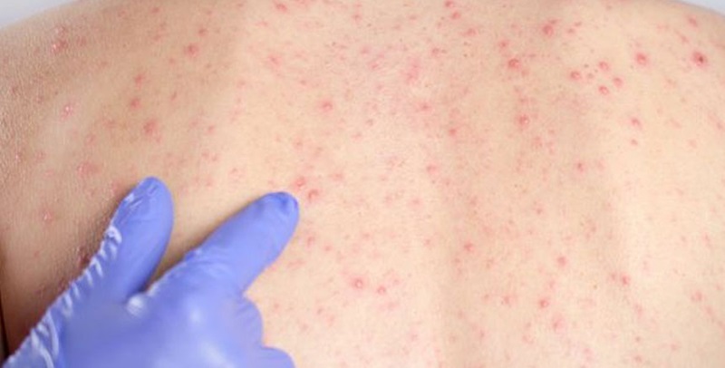 Acre pode enfrentar surto de sarampo caso cobertura vacinal continue baixa