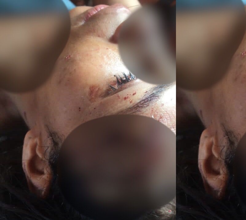 No interior, mulher é agredida e teve o rosto ferido com garrafadas em festa