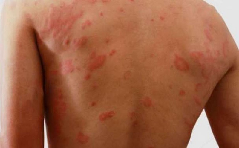 Semana Municipal de Combate à Hanseníase é realizada em Rio Branco