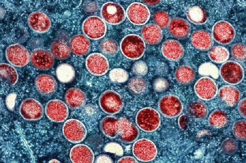 Acre notifica 1° caso suspeito de Varíola do Macaco em Rio Branco