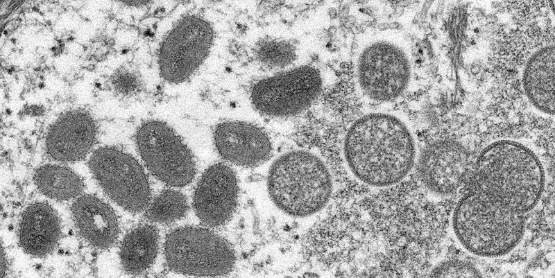 4° caso suspeito de Varíola do Macaco é notificado no Acre; primeiro foi descartado