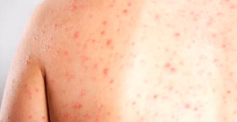 Caso suspeito de sarampo em criança de 4 anos é descartado  no Acre