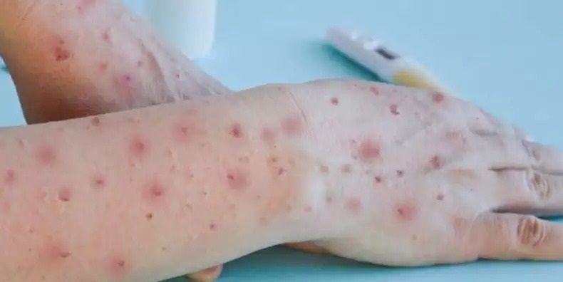 Acre notifica 6° caso suspeito de Varíola do Macaco em Cruzeiro do Sul