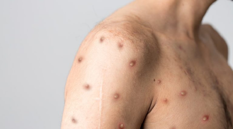 Sesacre divulga nota sobre casos suspeitos de monkeypox notificados em Rio Branco