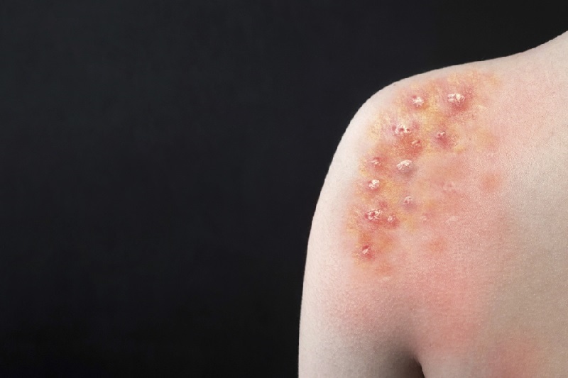 Criança de 8 anos está com suspeita de varíola dos macacos em Rio Branco