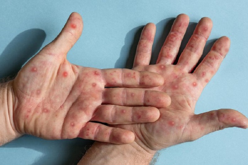 Rio Branco notifica dois casos suspeitos da varíola dos macacos nesta segunda-feira