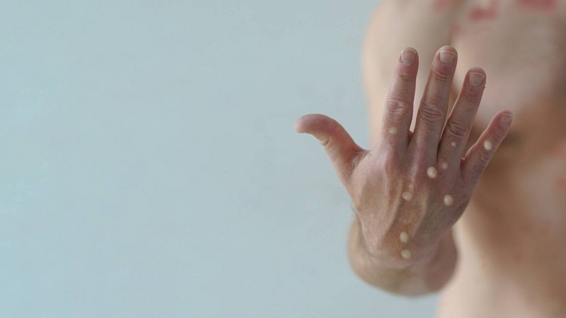 Em Rio Branco, um caso suspeito da varíola dos macacos é notificado nesta quinta-feira