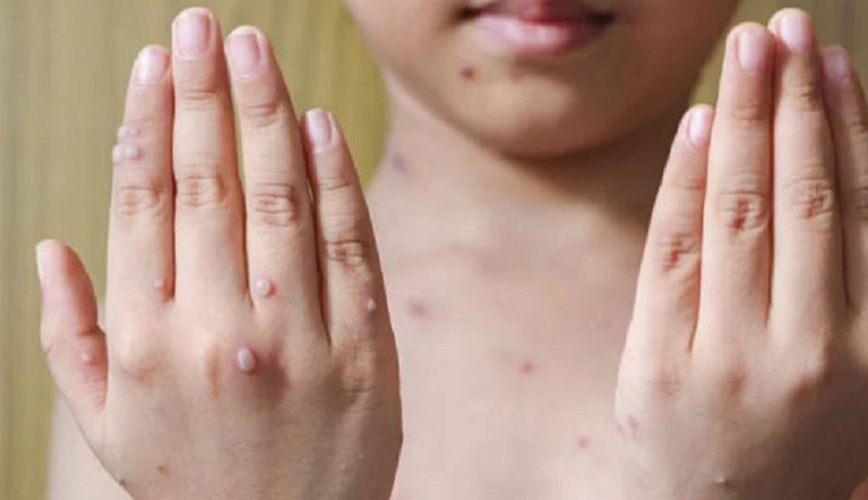 No município de Xapuri, criança de quatro anos está com suspeita da varíola dos macacos