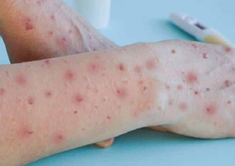 Criança de cinco anos está com suspeita da varíola dos macacos em Rio Branco