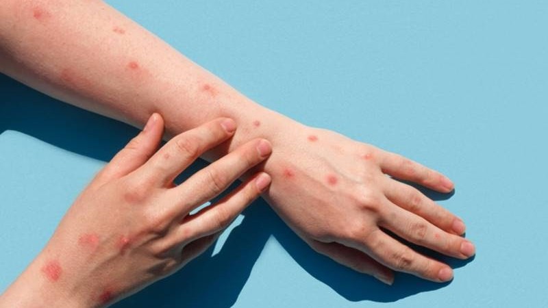 CIEVS Acre descarta cinco casos suspeitos da varíola dos macacos no estado