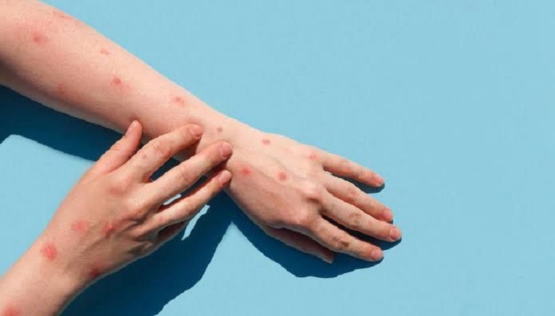 Saúde descarta caso suspeito de monkeypox no Acre