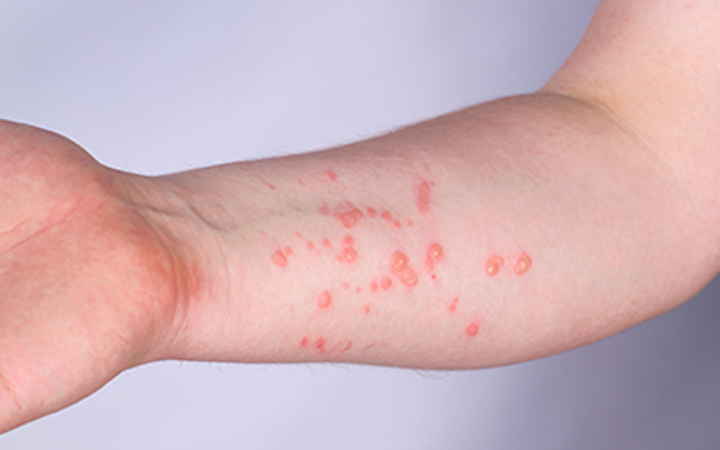 Saúde do Acre descarta caso suspeito de monkeypox e notifica mais um em Rio Branco