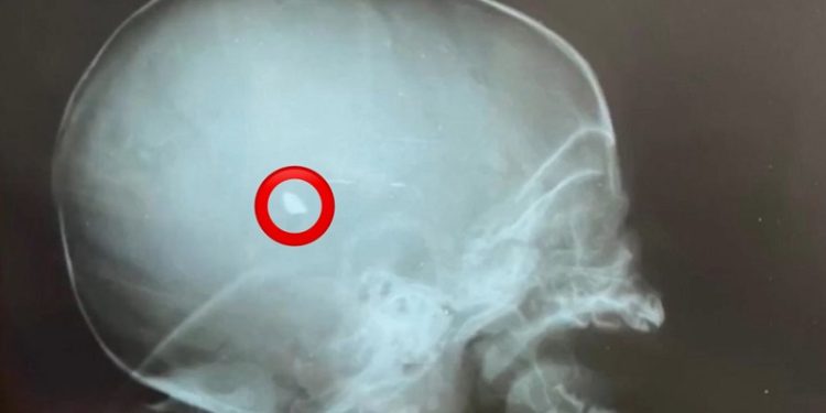 Bebê de dois meses atingido por tiro em Rio Branco segue na UTI e com bala alojada na cabeça