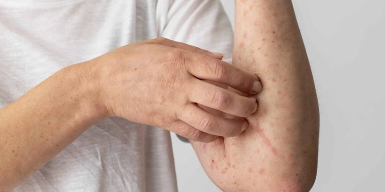 MPF e MPAC recomendam medidas de prevenção e tratamento para casos de Febre do Oropouche