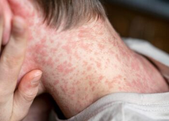 Acre reforça vigilância na fronteira após 80 casos de sarampo na Bolívia