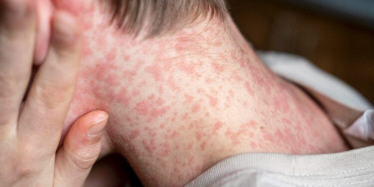 Acre reforça vigilância na fronteira após 80 casos de sarampo na Bolívia