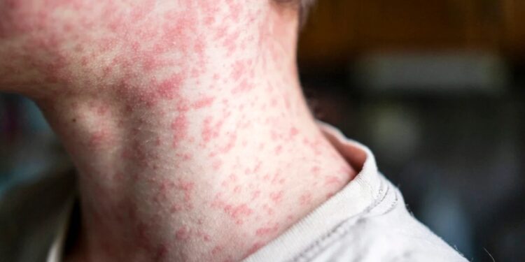 Acre declara emergência em saúde pública após 6 casos suspeitos de sarampo em cinco cidades