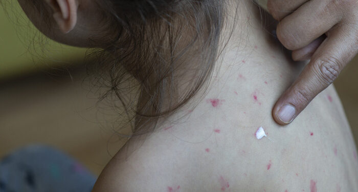 Casos suspeitos de sarampo sobem para 22 no Acre e autoridades reforçam alerta