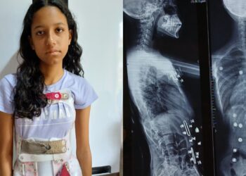 Pais criam vaquinha online para custear cirurgia de adolescente com escoliose