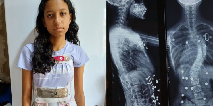 Pais criam vaquinha online para custear cirurgia de adolescente com escoliose